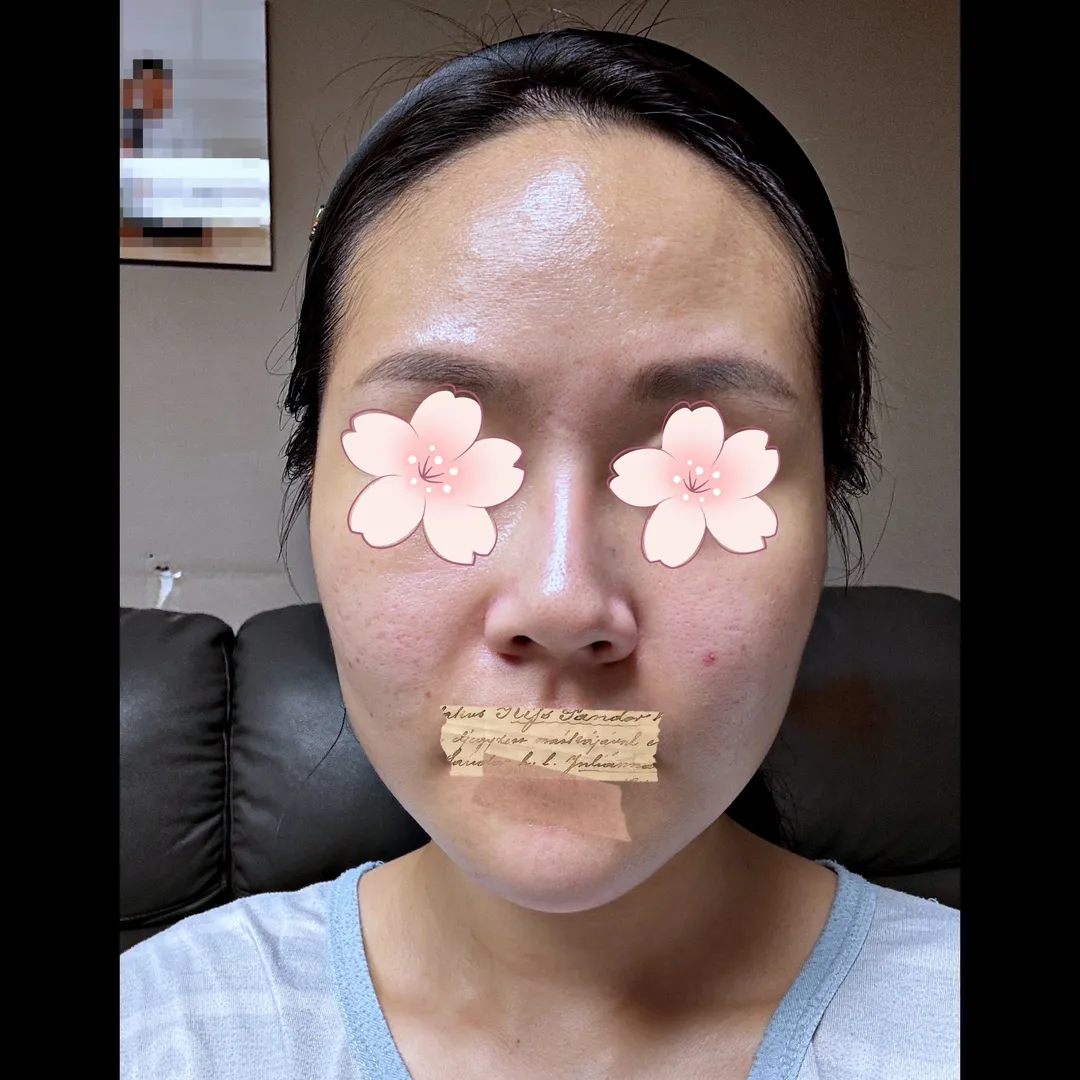 Rhinoplasty Revision 1