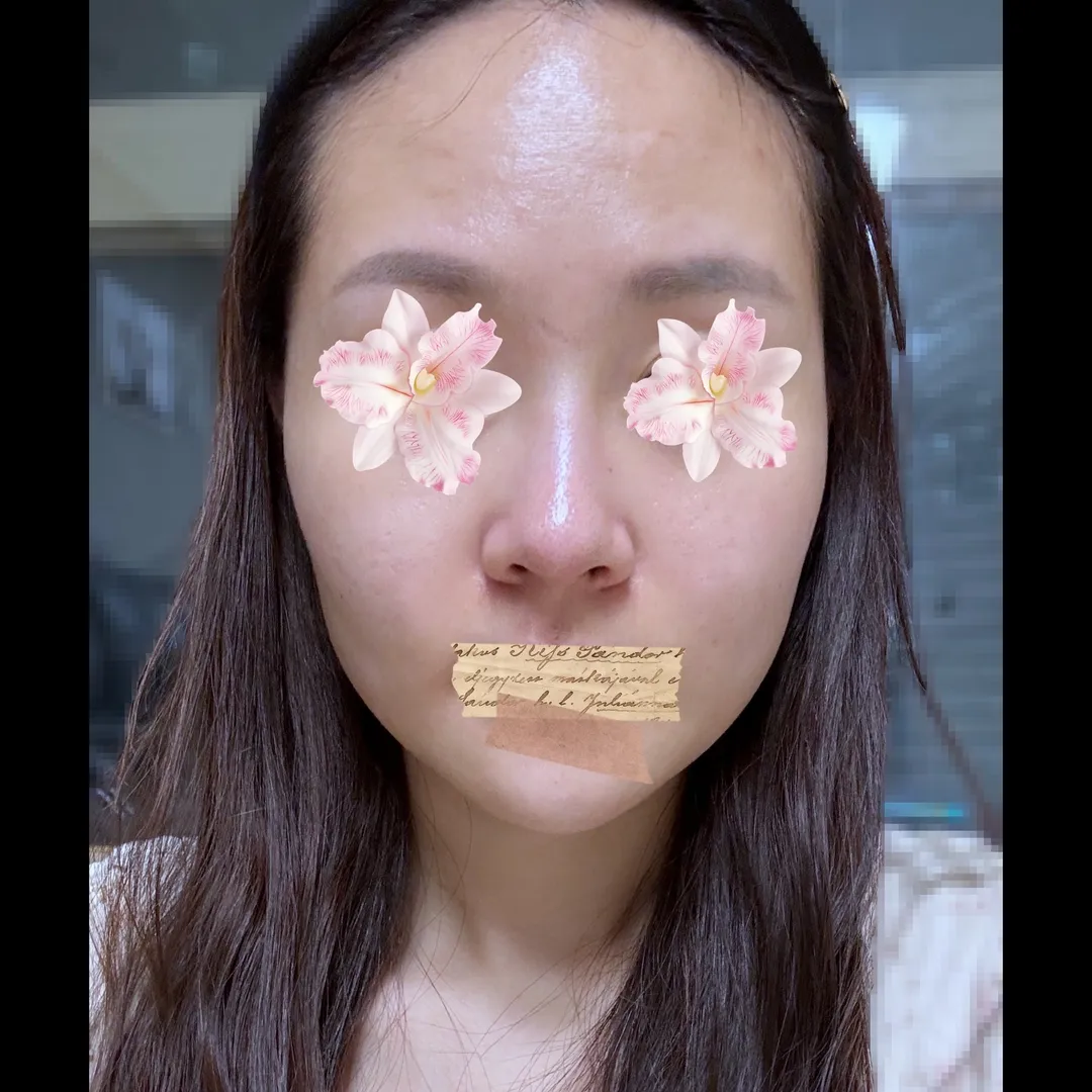 Rhinoplasty Revision 2