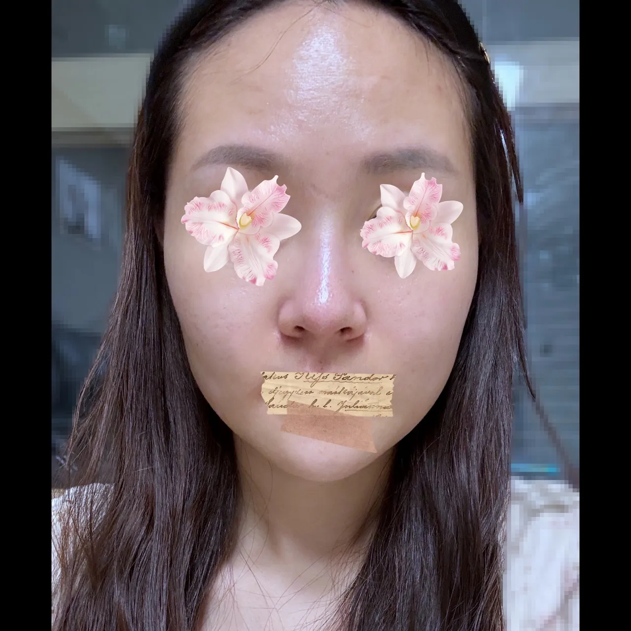Rhinoplasty Revision — Yerom Plastic Surgery 2
