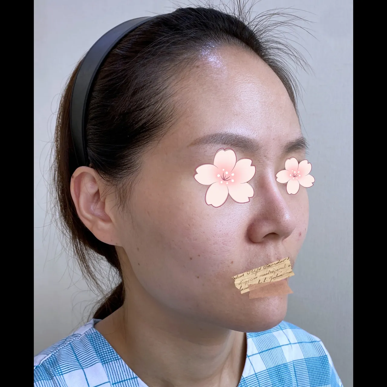 Rhinoplasty Revision — Yerom Plastic Surgery 3
