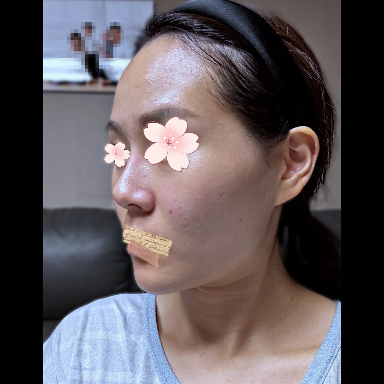 Rhinoplasty Revision — Yerom Plastic Surgery 5