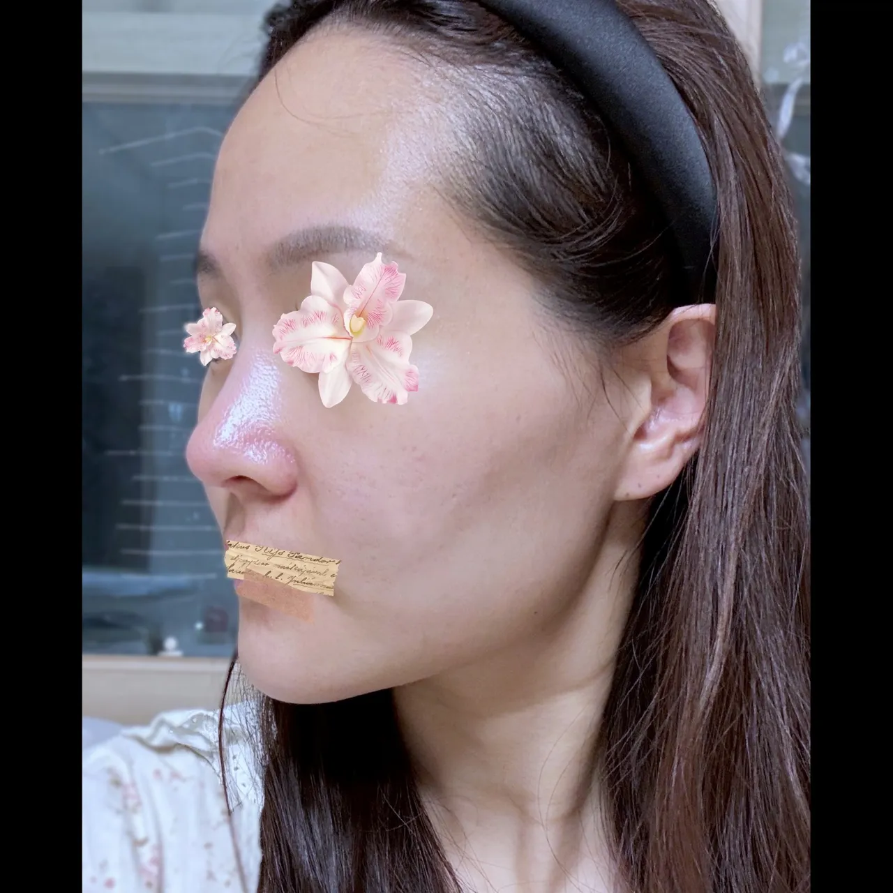 Rhinoplasty Revision — Yerom Plastic Surgery 6