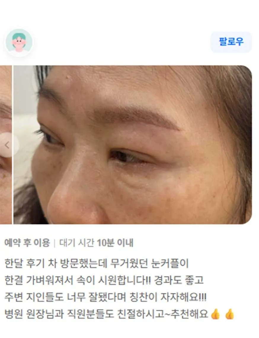 Lower Eyelid Fat Repositioning 1