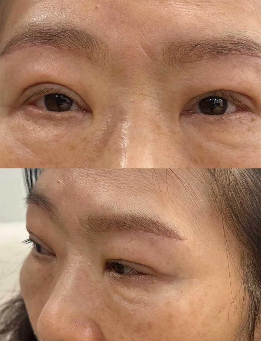 Lower Eyelid Fat Repositioning 2