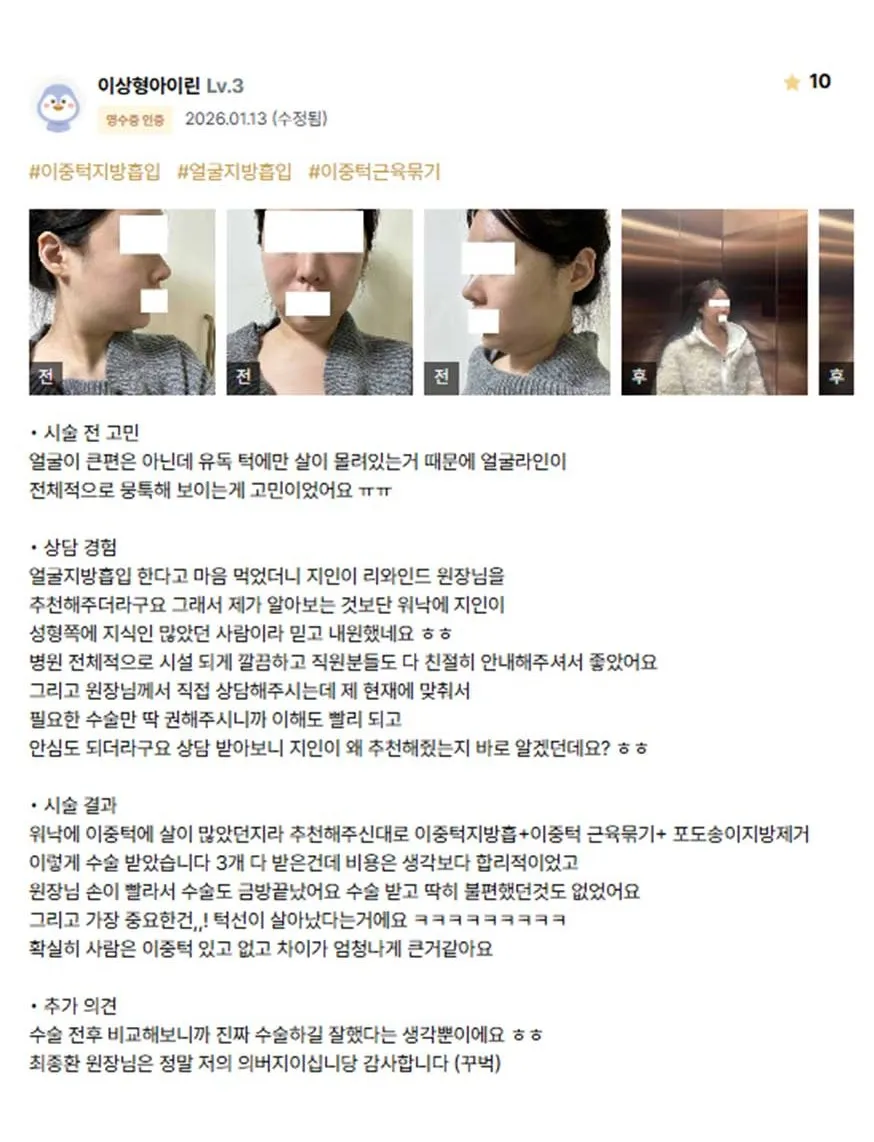 Chin Liposuction 1