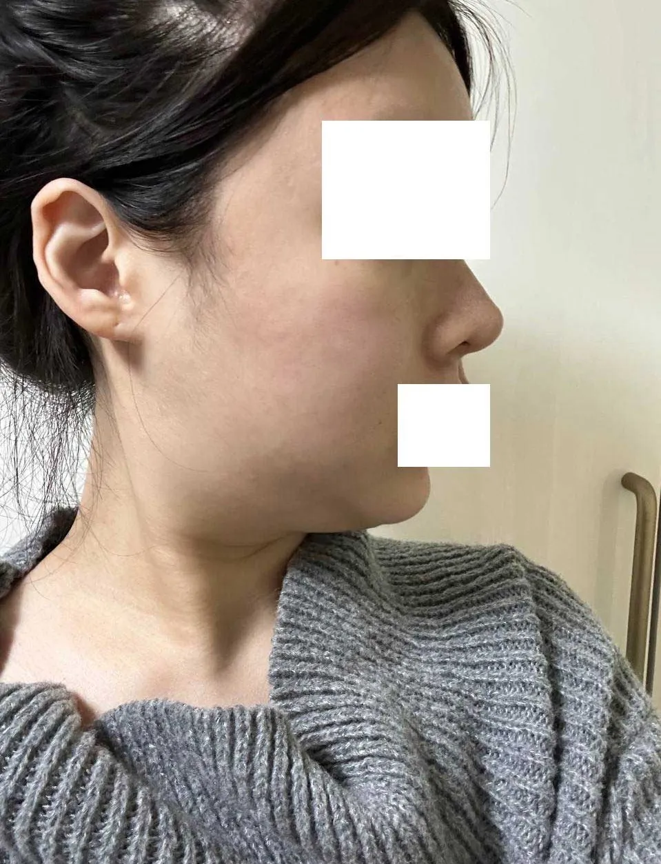 Chin Liposuction 2