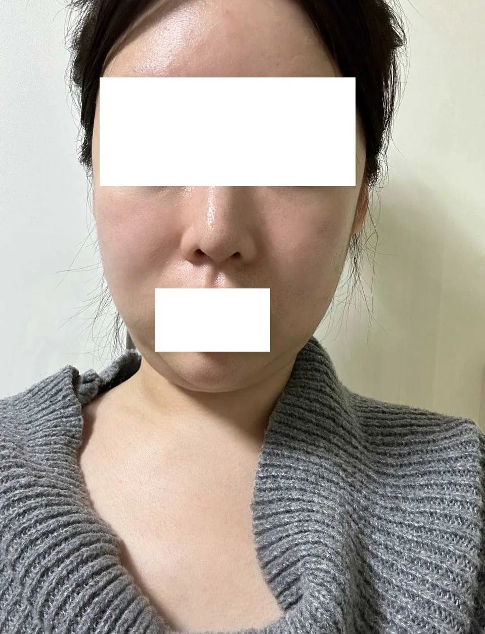 Chin Liposuction — Rewind Plastic Surgery 3