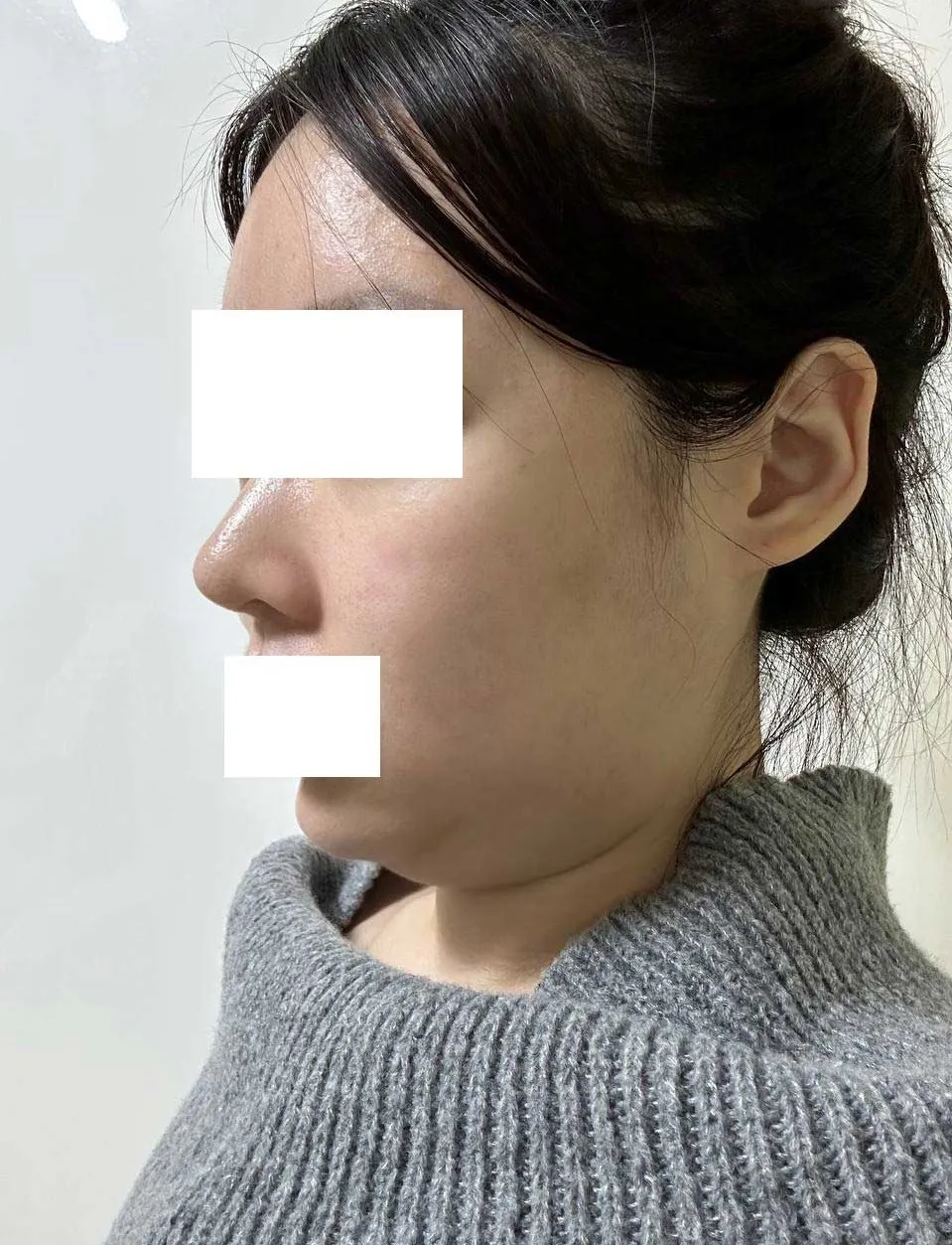 Chin Liposuction — Rewind Plastic Surgery 4