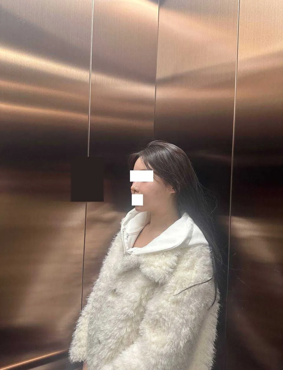 Chin Liposuction — Rewind Plastic Surgery 6