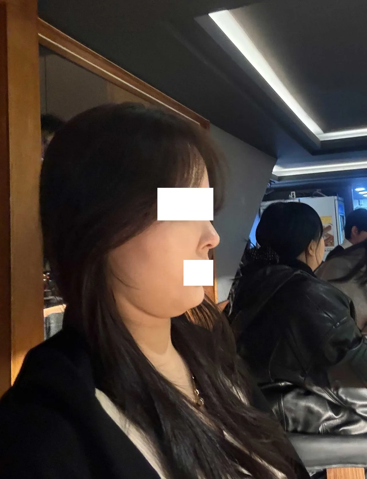 Chin Liposuction — Rewind Plastic Surgery 2