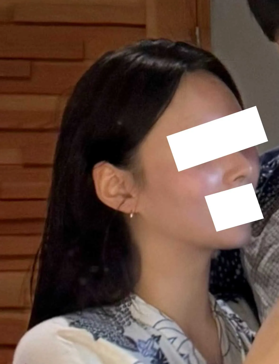 Chin Liposuction — Rewind Plastic Surgery 4