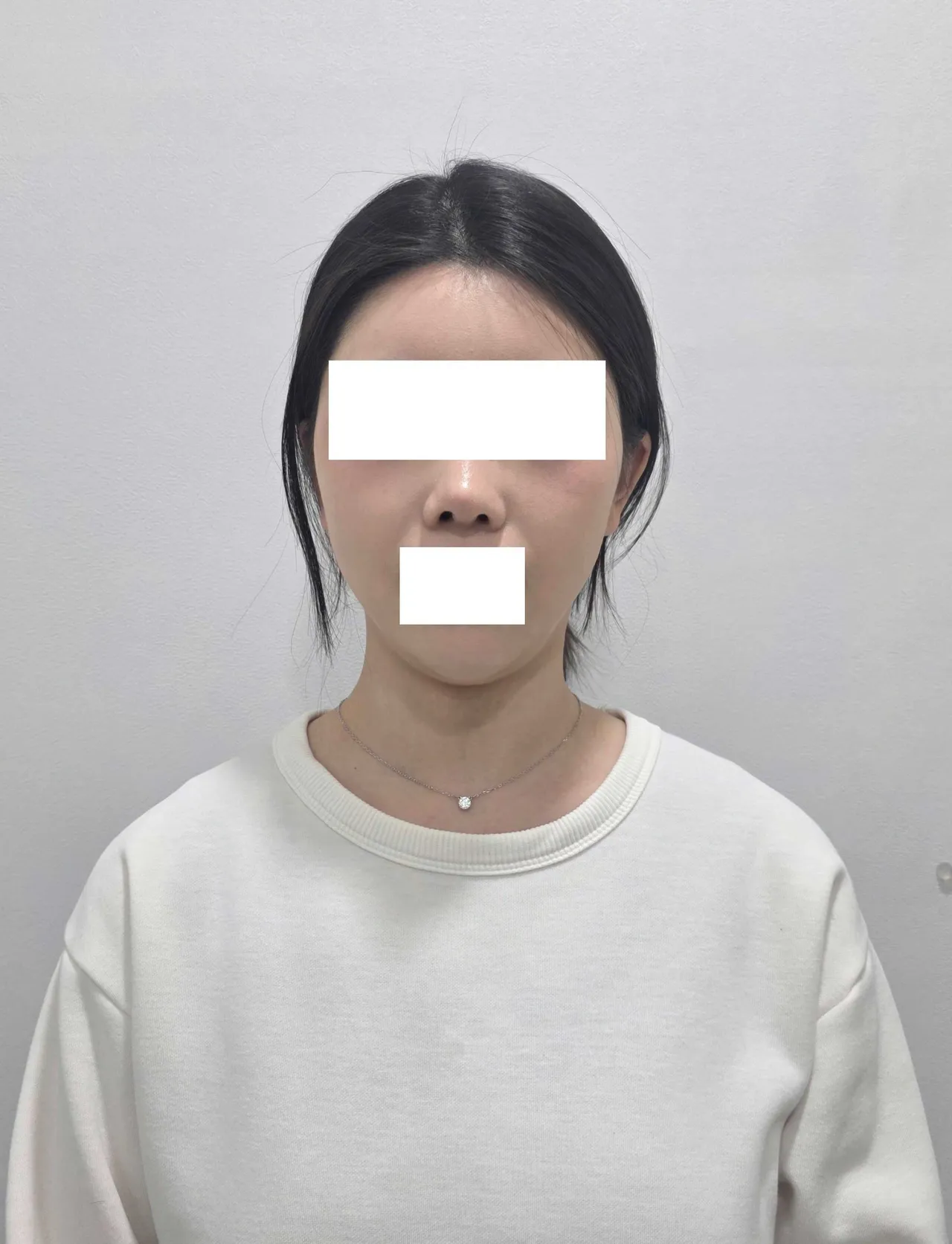 Chin Liposuction — Rewind Plastic Surgery 2