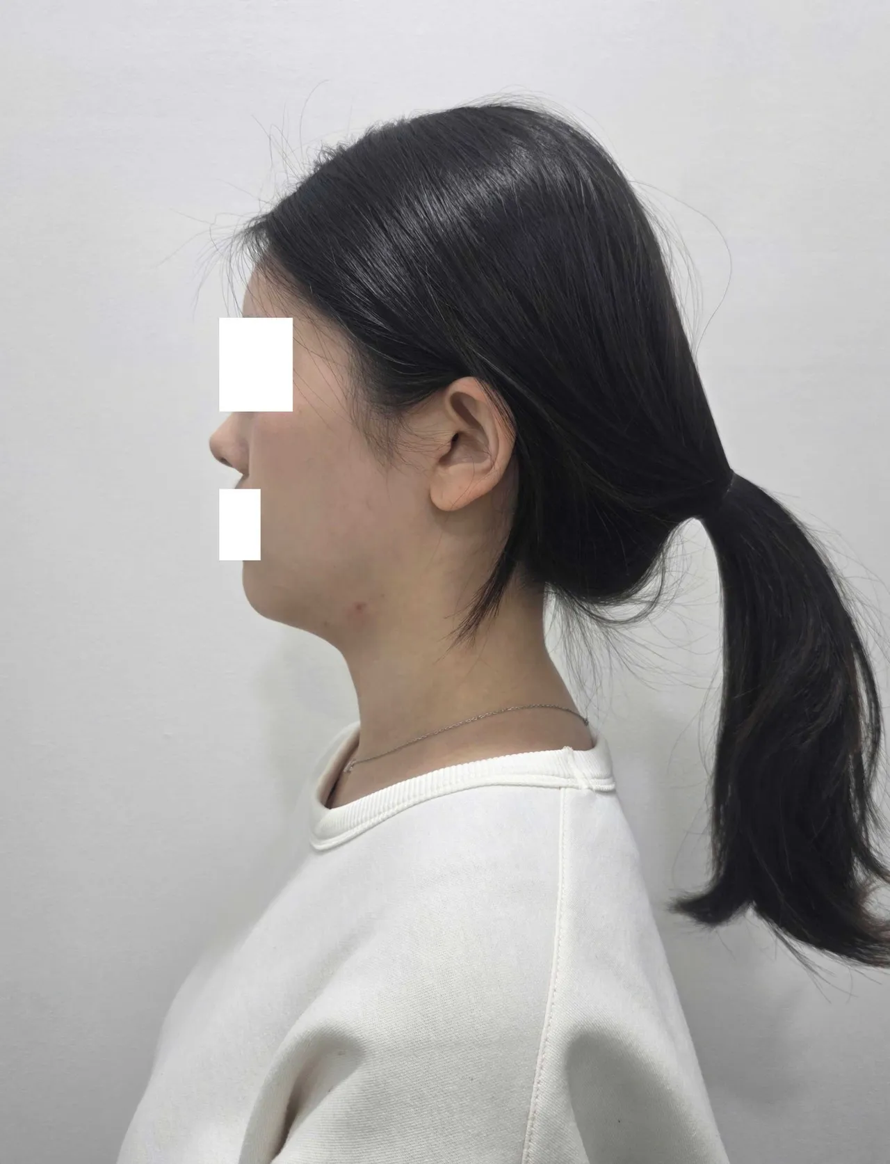 Chin Liposuction — Rewind Plastic Surgery 3