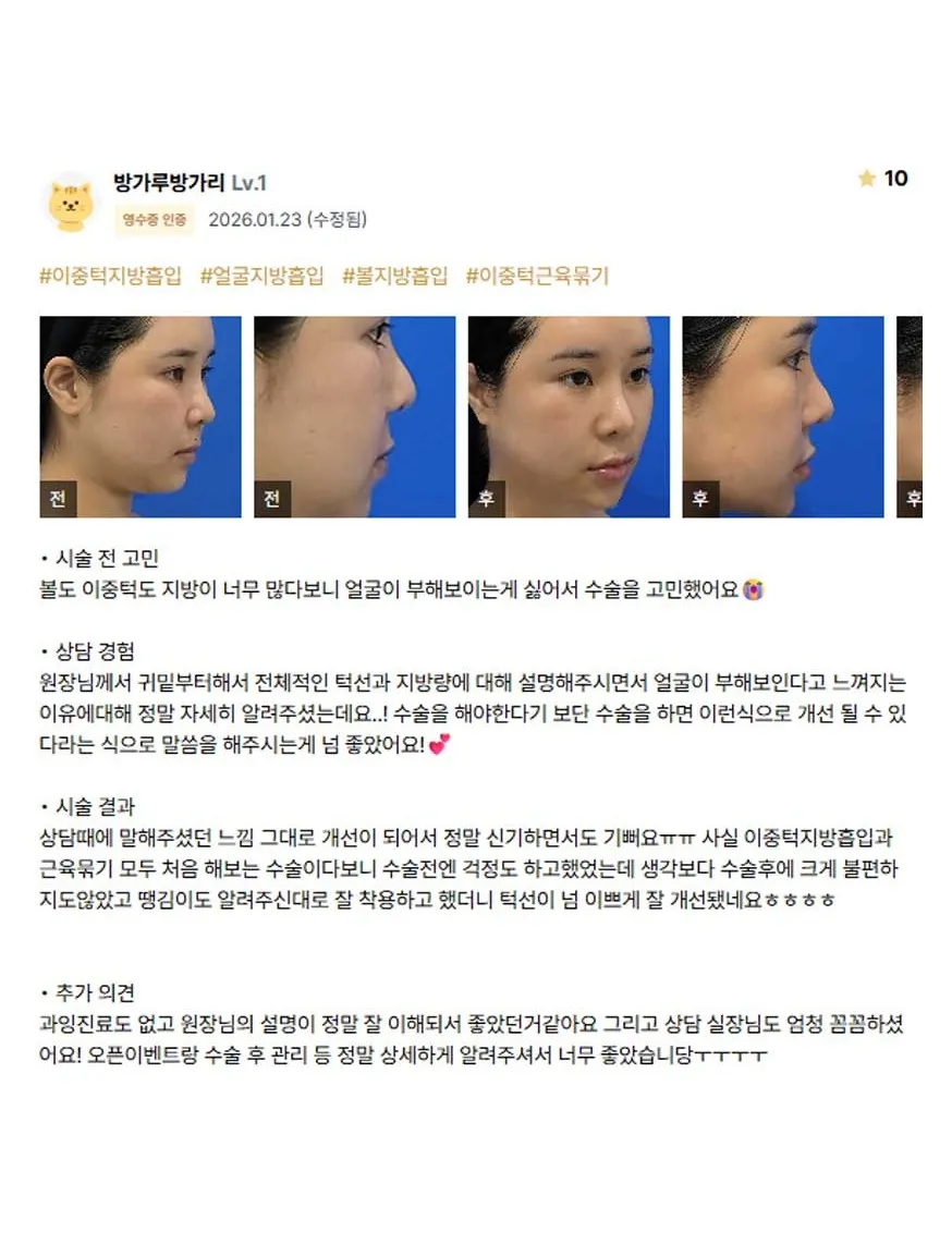 Chin Liposuction 1