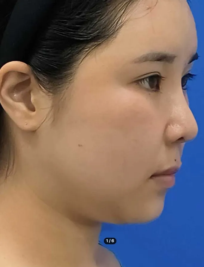 Chin Liposuction 2
