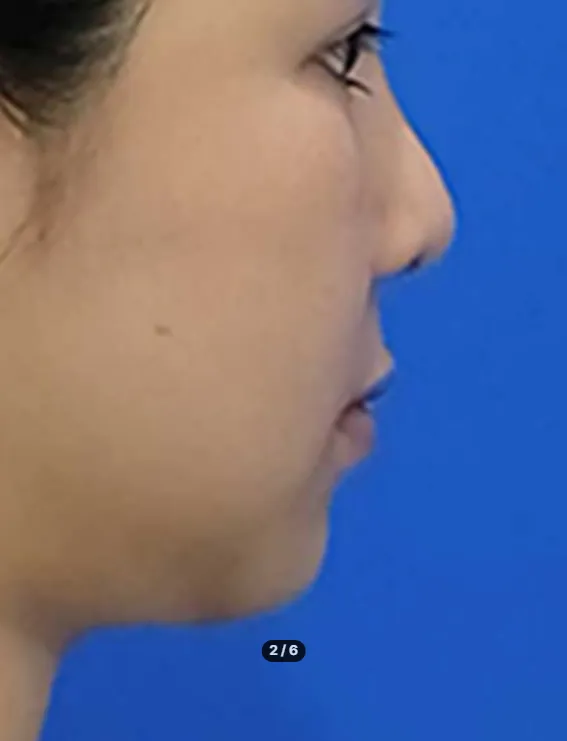 Chin Liposuction — Rewind Plastic Surgery 3