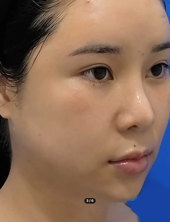 Chin Liposuction — Rewind Plastic Surgery 4