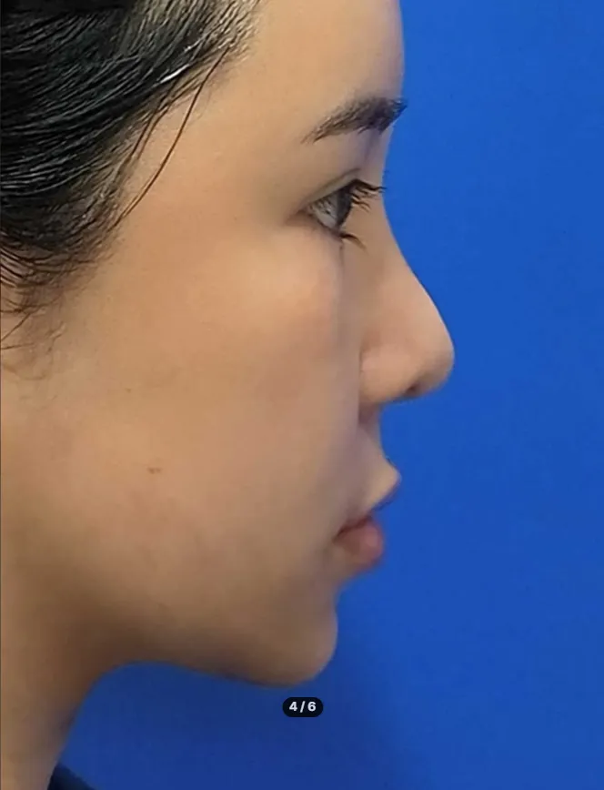 Chin Liposuction — Rewind Plastic Surgery 5