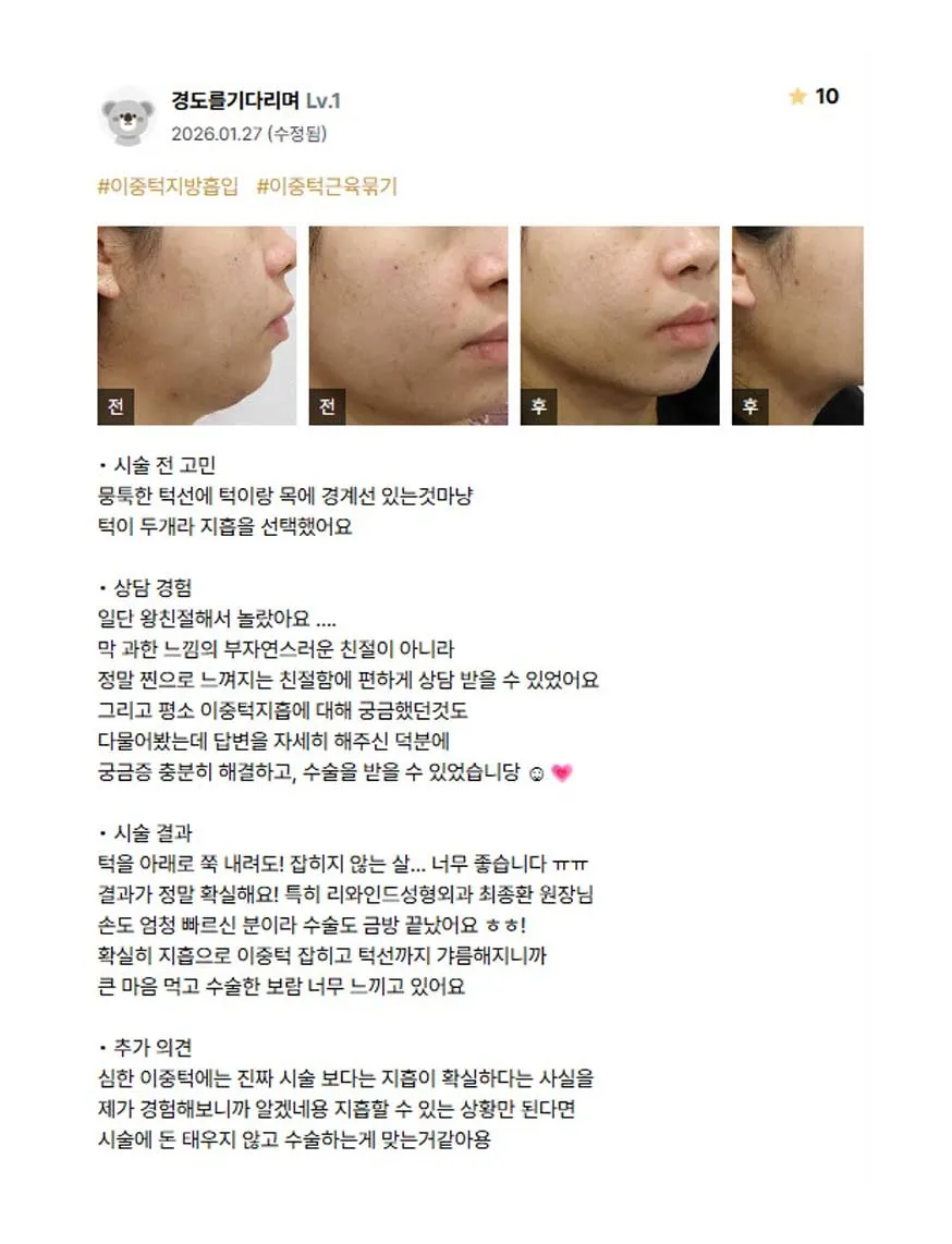 Chin Liposuction 1