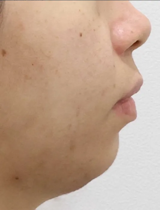 Chin Liposuction 2