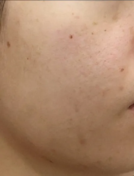 Chin Liposuction — Rewind Plastic Surgery 3