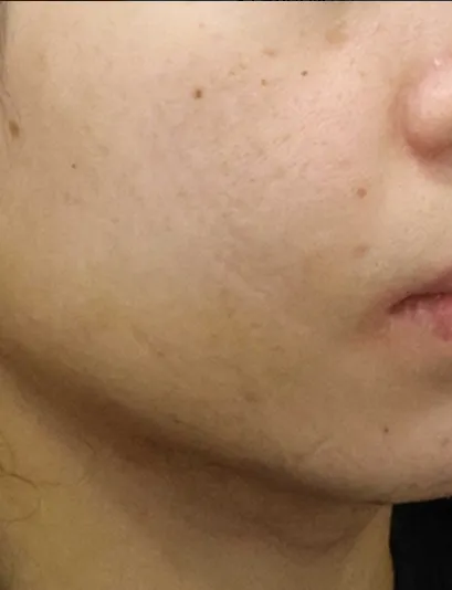 Chin Liposuction — Rewind Plastic Surgery 4