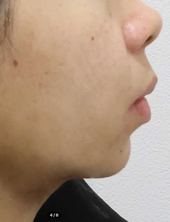 Chin Liposuction — Rewind Plastic Surgery 5