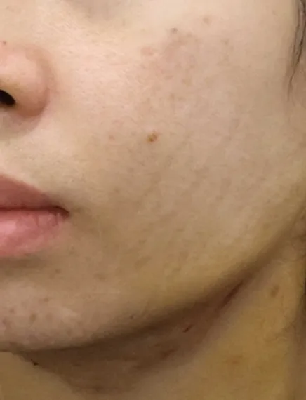 Chin Liposuction — Rewind Plastic Surgery 6