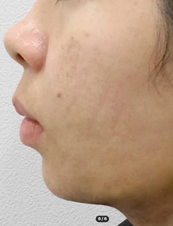 Chin Liposuction — Rewind Plastic Surgery 7