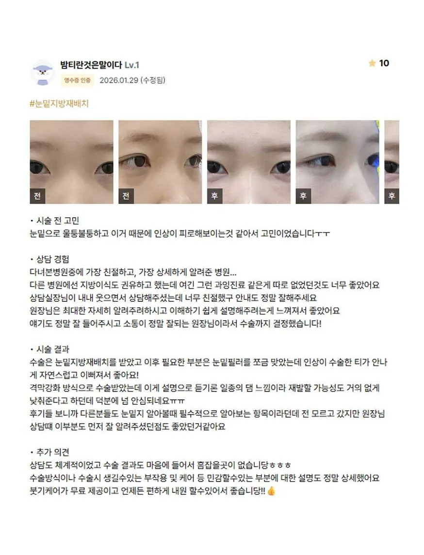 Lower Eyelid Fat Repositioning 1