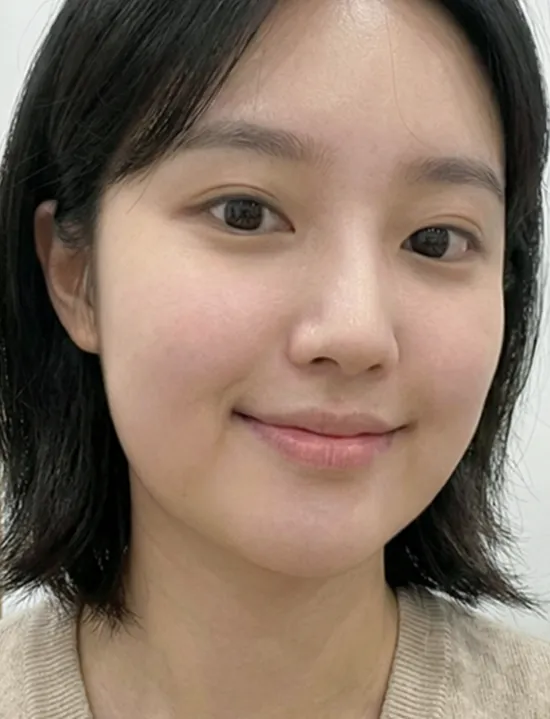 Chin Liposuction — Rewind Plastic Surgery 2