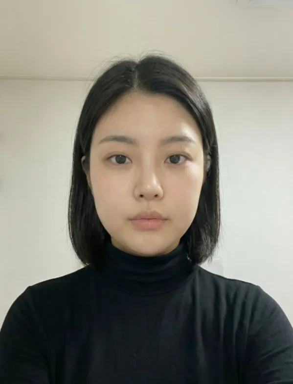 Chin Liposuction 2