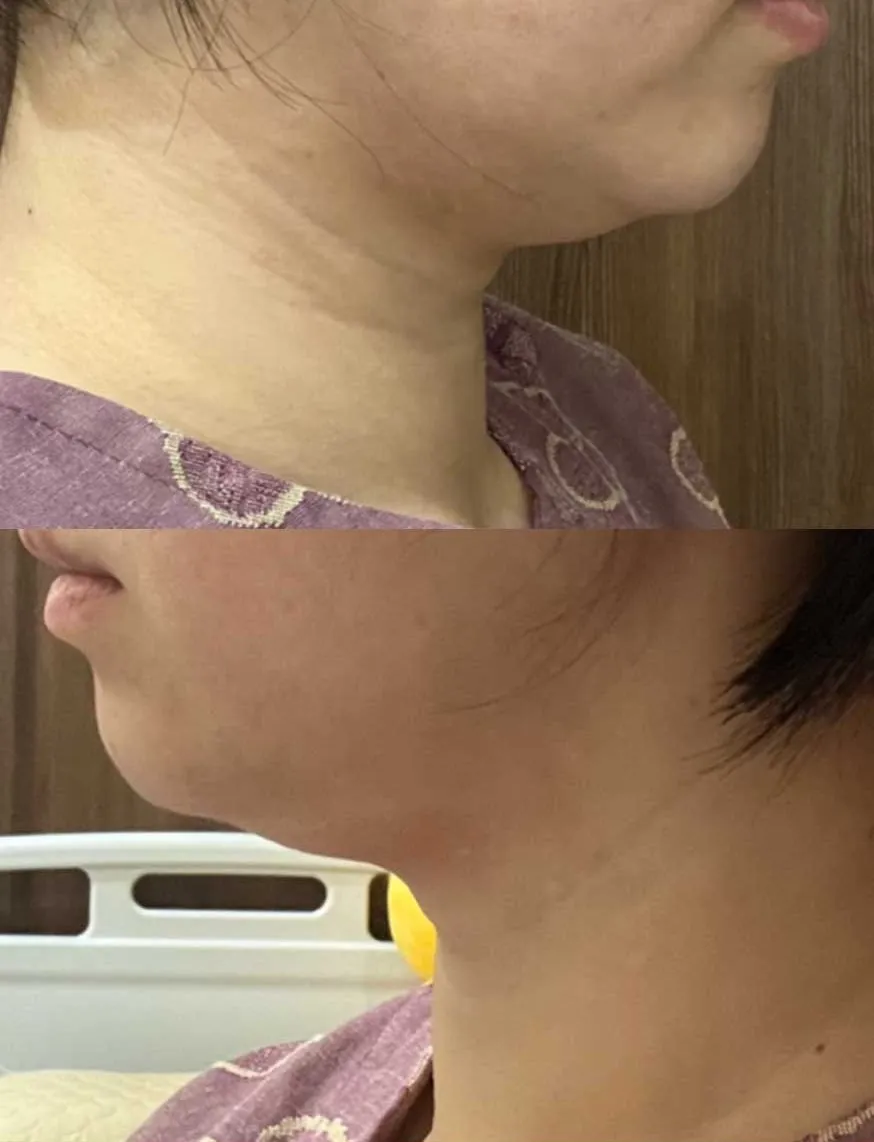 Chin Liposuction — Rewind Plastic Surgery 2
