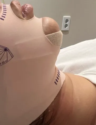 Chin Liposuction — Rewind Plastic Surgery 3