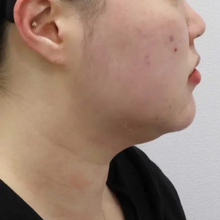 Chin Liposuction — Rewind Plastic Surgery 2