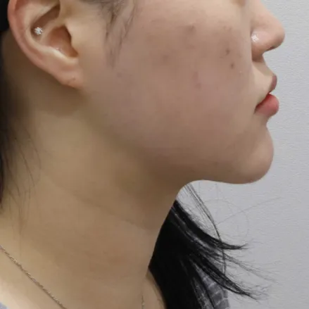 Chin Liposuction — Rewind Plastic Surgery 3