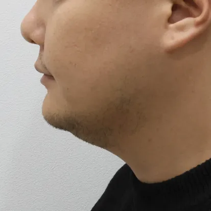Chin Liposuction — Rewind Plastic Surgery 2