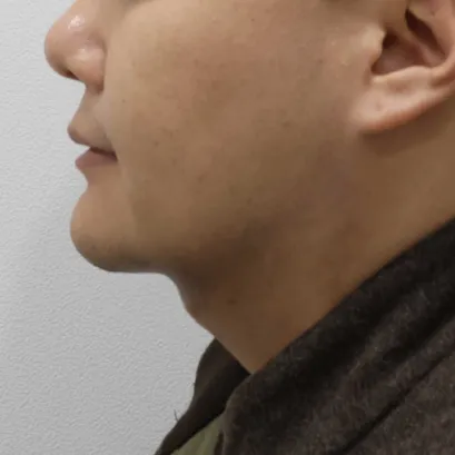 Chin Liposuction — Rewind Plastic Surgery 3