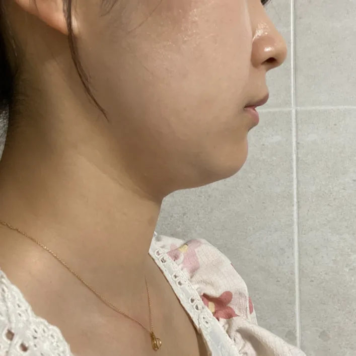 Chin Liposuction 2