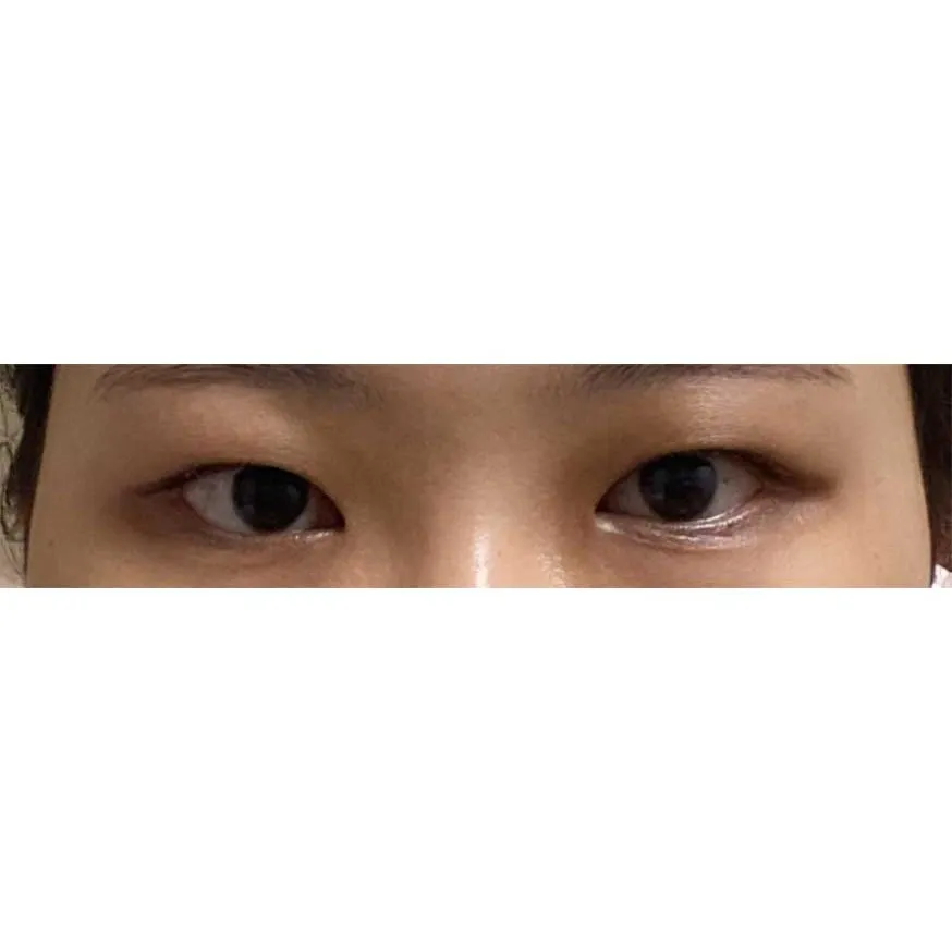Chin Liposuction — Rewind Plastic Surgery 3