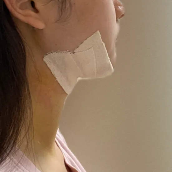 Chin Liposuction — Rewind Plastic Surgery 4