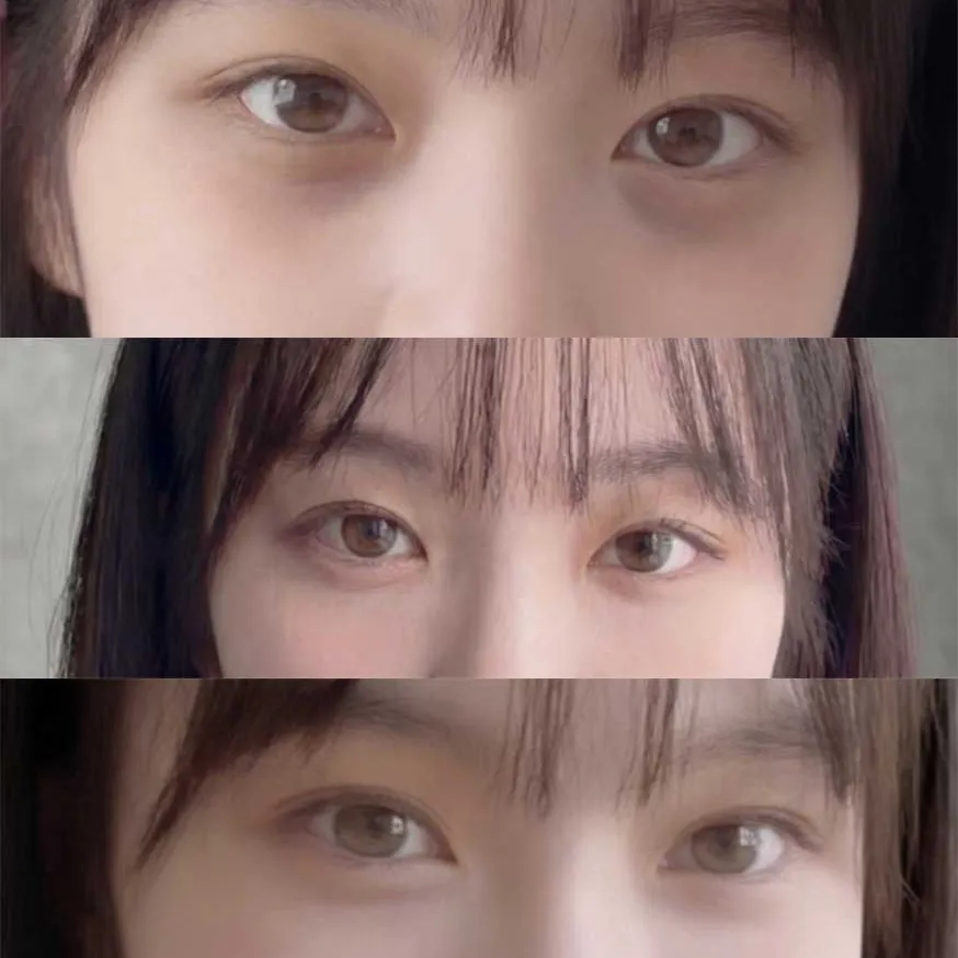 Lower Eyelid Fat Repositioning — Rewind Plastic Surgery 2