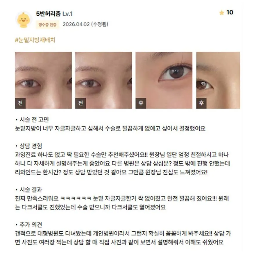 Lower Eyelid Fat Repositioning 1