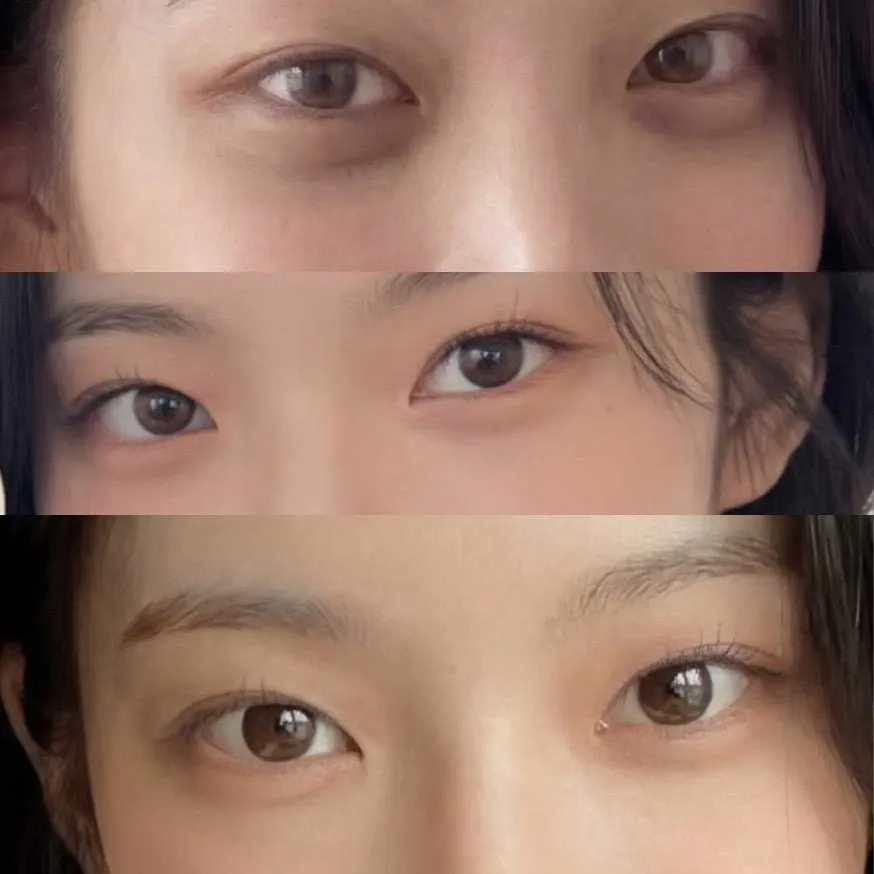 Lower Eyelid Fat Repositioning — Rewind Plastic Surgery 2
