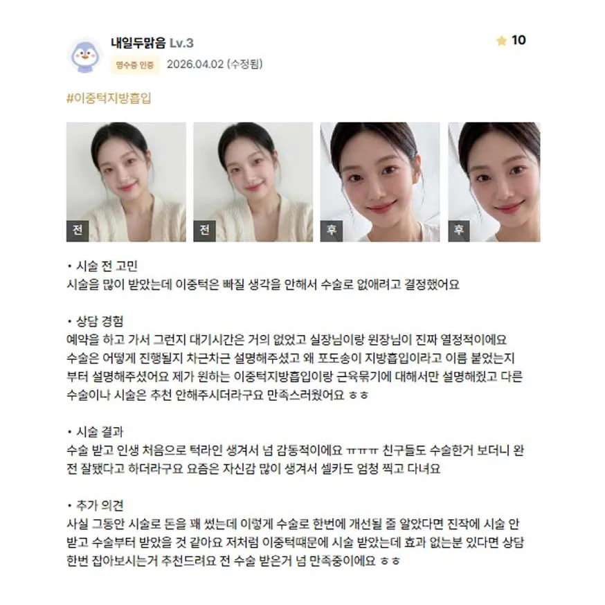 Chin Liposuction 1