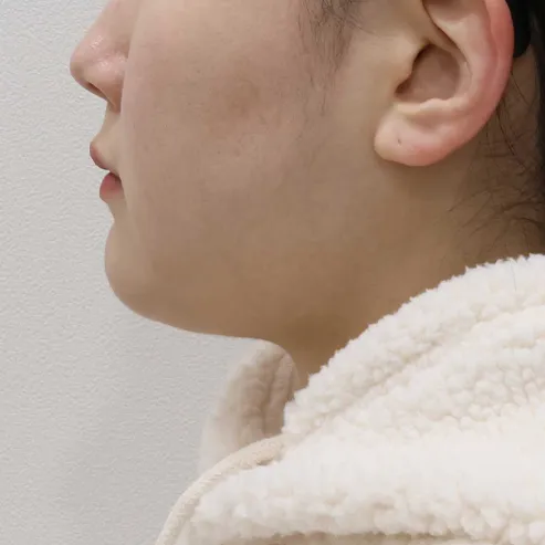 Chin Liposuction 2