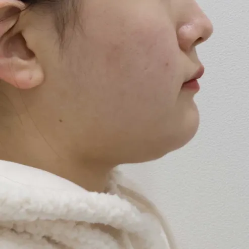 Chin Liposuction — Rewind Plastic Surgery 3