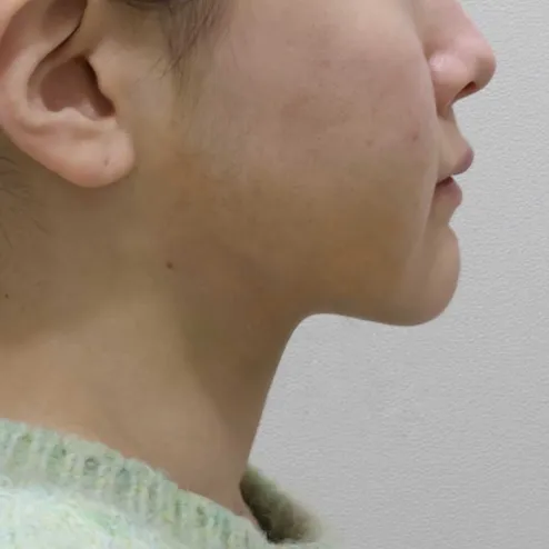 Chin Liposuction — Rewind Plastic Surgery 4