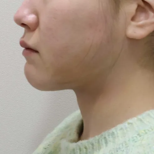 Chin Liposuction — Rewind Plastic Surgery 5