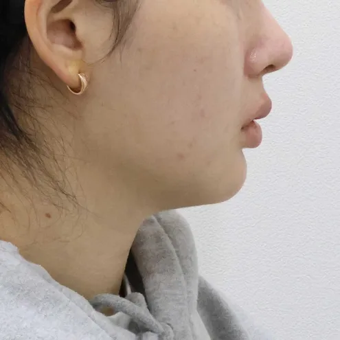 Chin Liposuction — Rewind Plastic Surgery 1